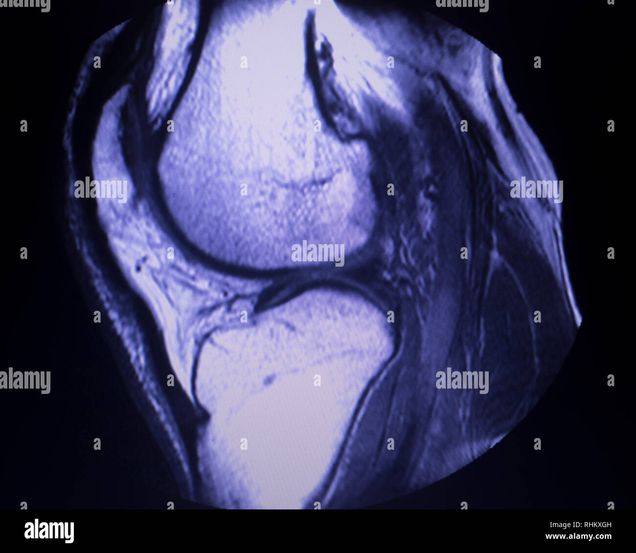 Imágenes por resonancia magnética IRM de la rodilla cuerno posterior
