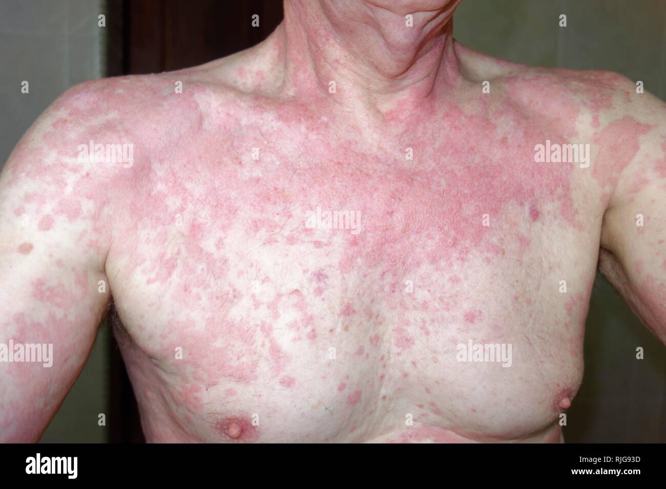El hombre, de 68 años de edad, con una reacción alérgica, erupciones cutáneas, alergias, repelente de insectos baygón, Indonesia Foto de stock