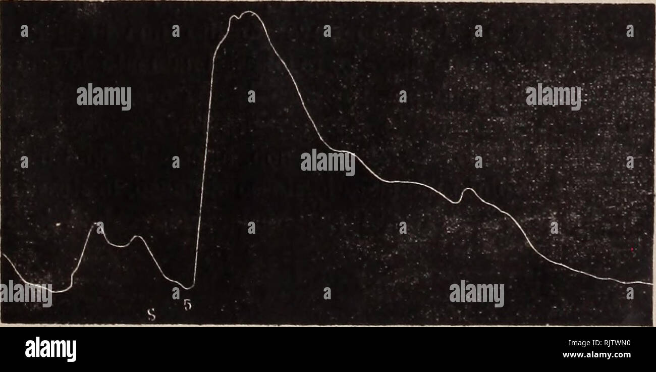 . Atti della Società toscana di Scienze naturali, residente en Pisa. Historia natural. SULL INNERVAZIONE DELLO STOMACO NELLA RANA 379 "Ricerche praticate sullo stomaco en movimento cou eccitamenti di varia intensità del vago e del simpatico. Pel vago le eccitazioni deboli sembrano accelerare il ritmo stomacale (Tr. T. 15); quelle di media intensità tendono un ral- lentarlo (id. B 10): le forti lo rallentano enormemente (id. C 5) o lo arrestano il più delle volte, dopo provocata anu- zione tetanica contras. / J fA v YVv,/^ ⢠Tracciato N. I. Pel simpatico non ho potuto acondicionado abbastanza sicur Foto de stock