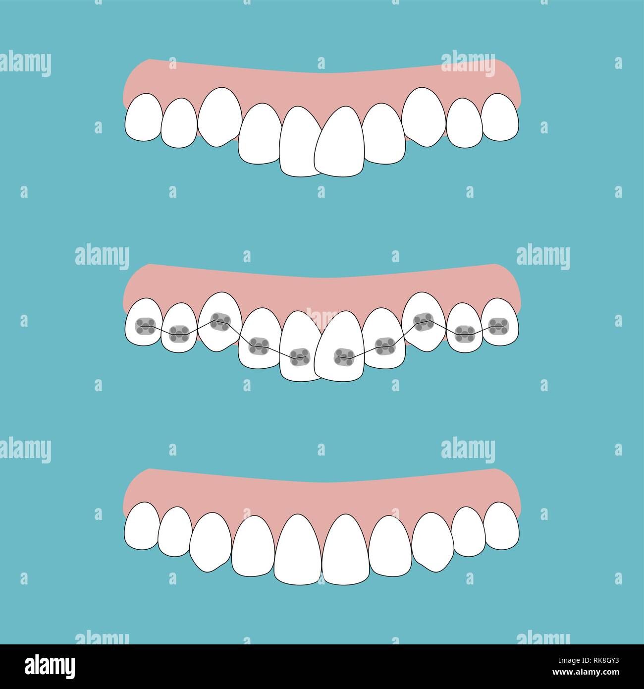 Ilustración vectorial de las etapas de tratamiento ortodóncico llaves