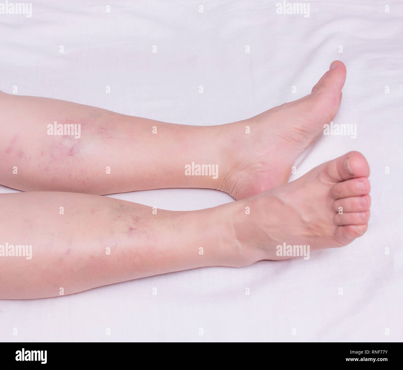 Arriba 94+ Foto Imágenes De Trombosis En Las Piernas Lleno