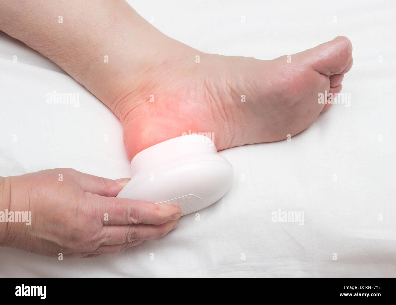 Mujer sana espolón calcáneo con el campo magnético del imán, fisioterapia,  tratamiento, close-up, fondo blanco, fascia, sales de calcio, la  inflamación Fotografía de stock - Alamy