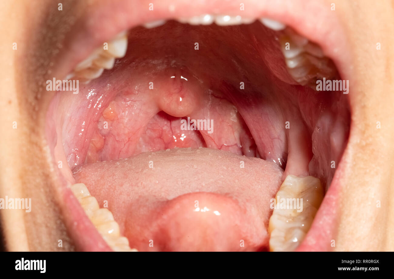 Dolor de garganta con la garganta inflamada. Closeup abrir boca con la pared faríngea posterior la hinchazón y la úvula y las amígdalas. En la parte posterior de folículos de Influenza Foto de stock