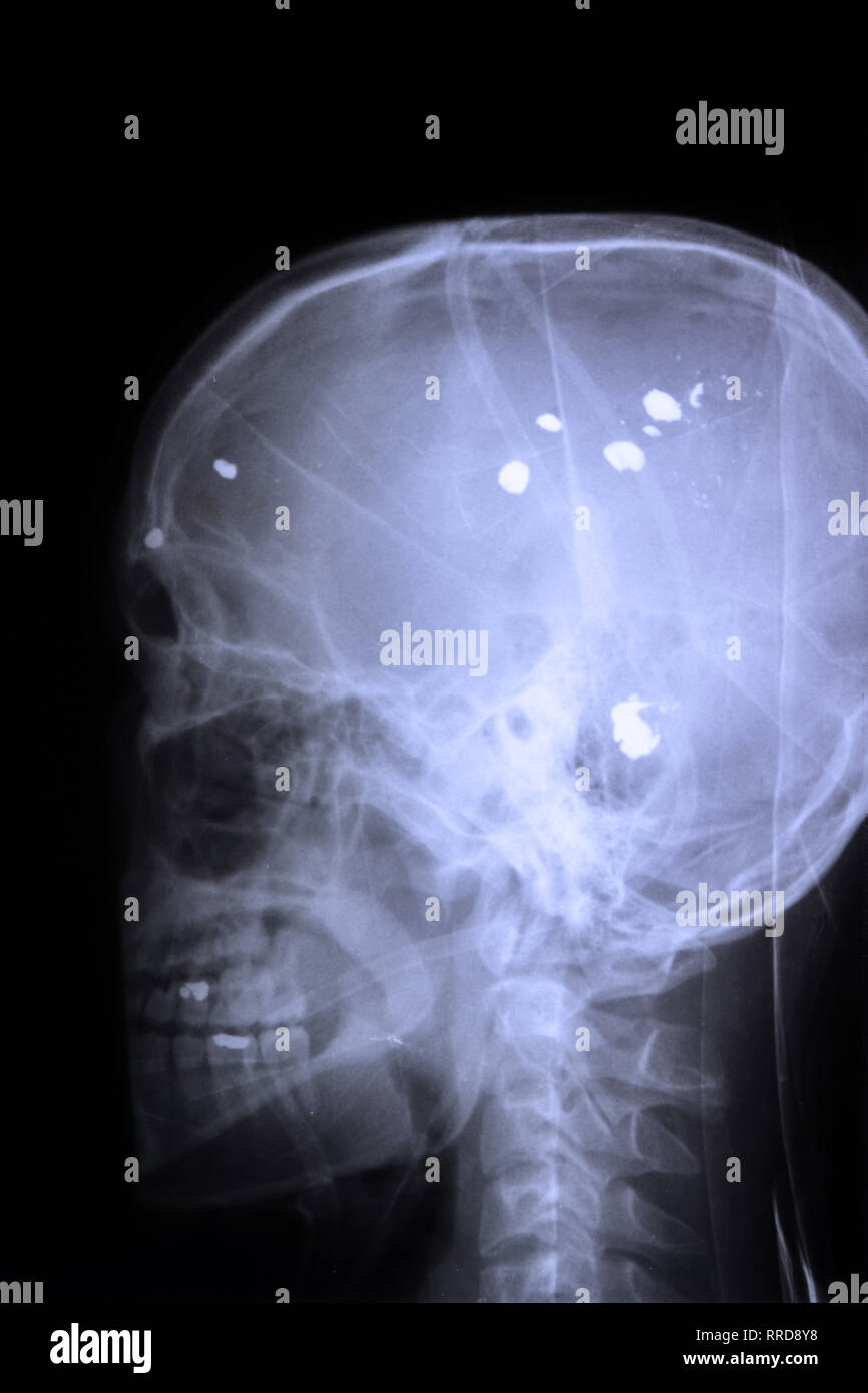 Imagen de rayos X de una bala de la pistola en la cabeza. Foto de stock