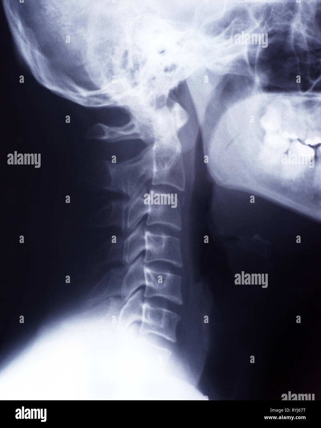 Radiografía de cuello y columna cervical, lateral, vista lateral Foto de stock
