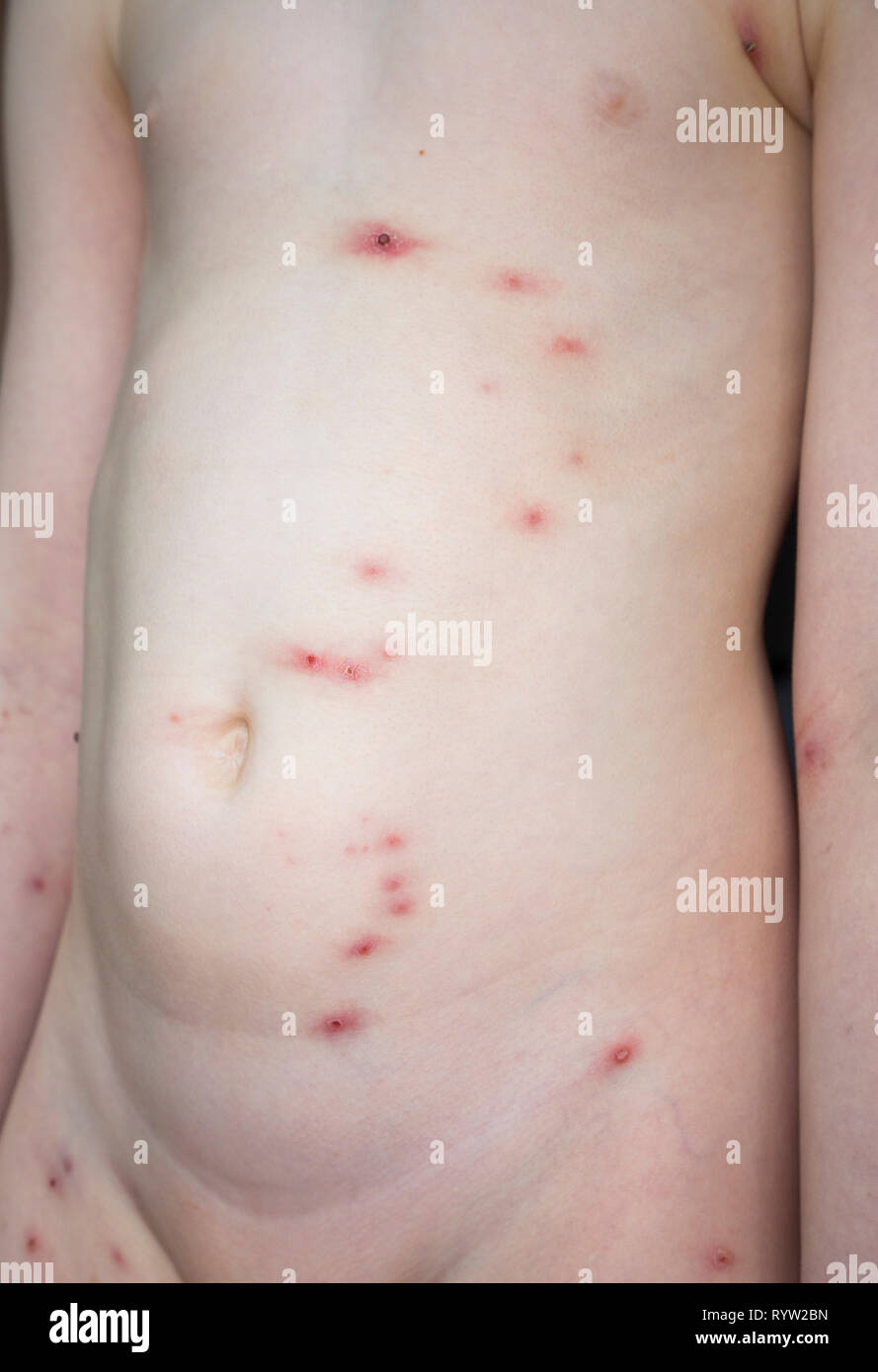 El cuerpo de una niña de seis años con el molusco contagioso puntos; un  común y generalmente inofensiva condición que causa manchas de erupción en  la piel. Es más común en niños
