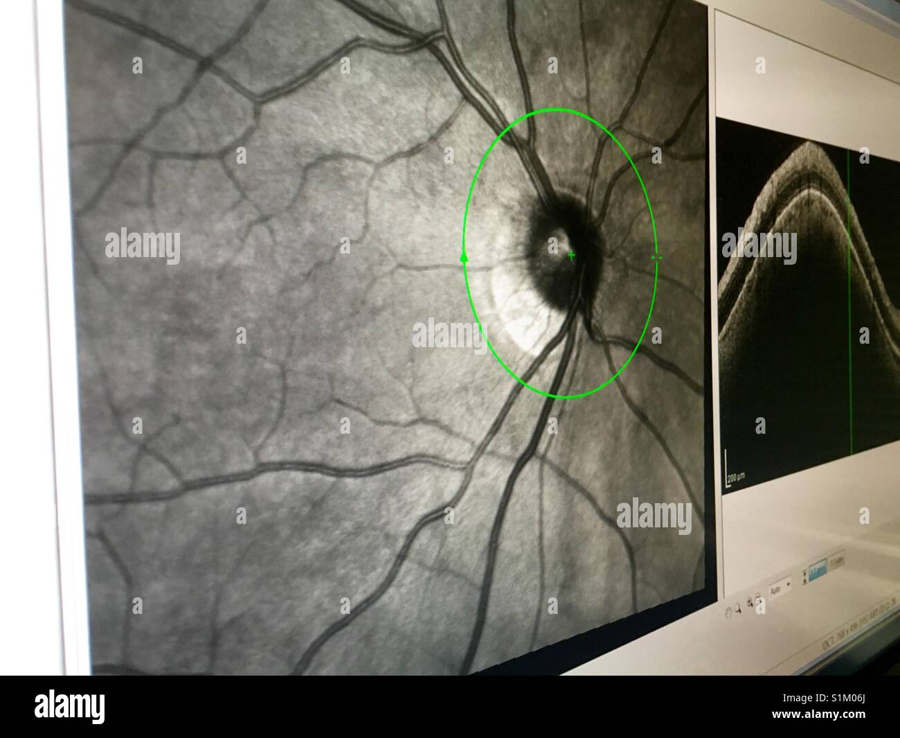 La tomografía computarizada de los nervios del ojo mostrando vasos sanguíneos en oficina Opthamalogist Foto de stock