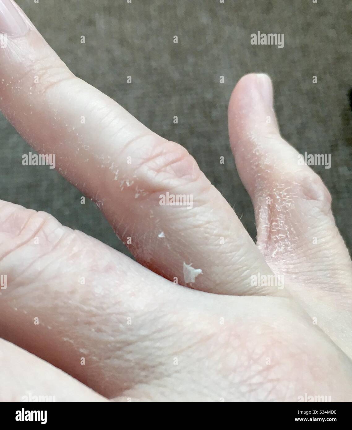 Enfermedad autoinmunitaria: Descamación de las manos irritada por el lavado de las manos durante el brote de covid19 coronavirus Foto de stock