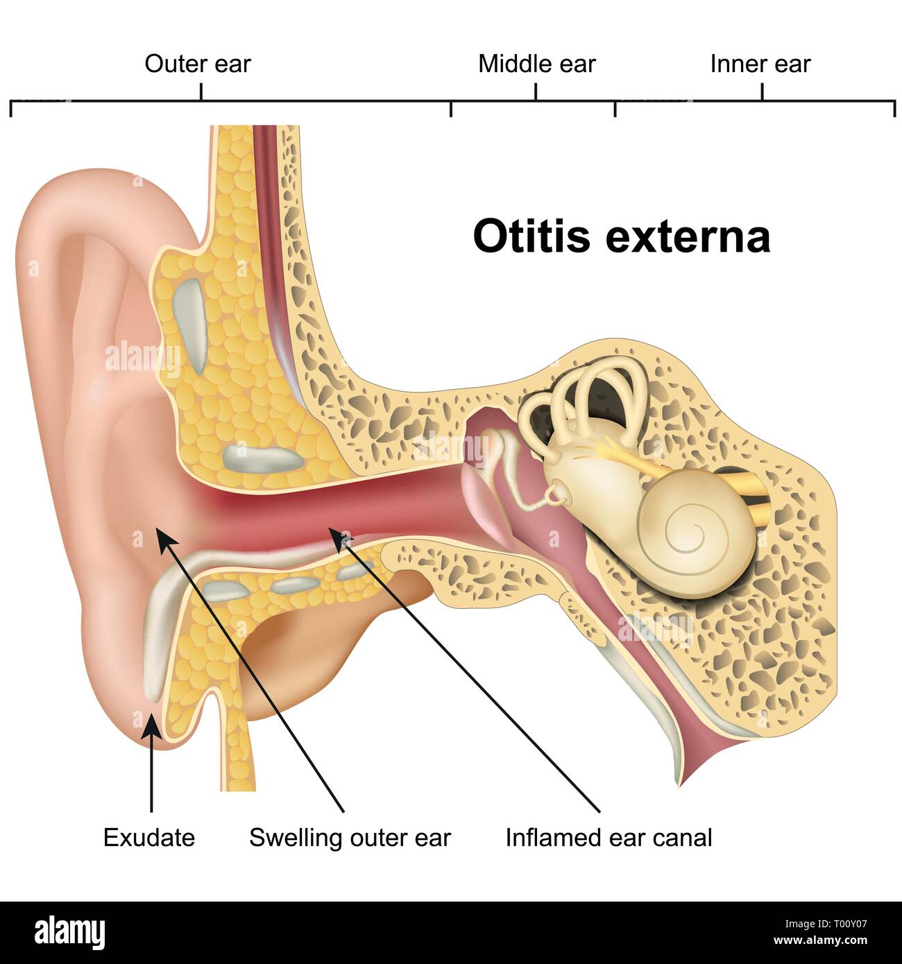 Otitis externa oreja enfermedad médica 3d ilustración vectorial sobre fondo blanco. Ilustración del Vector