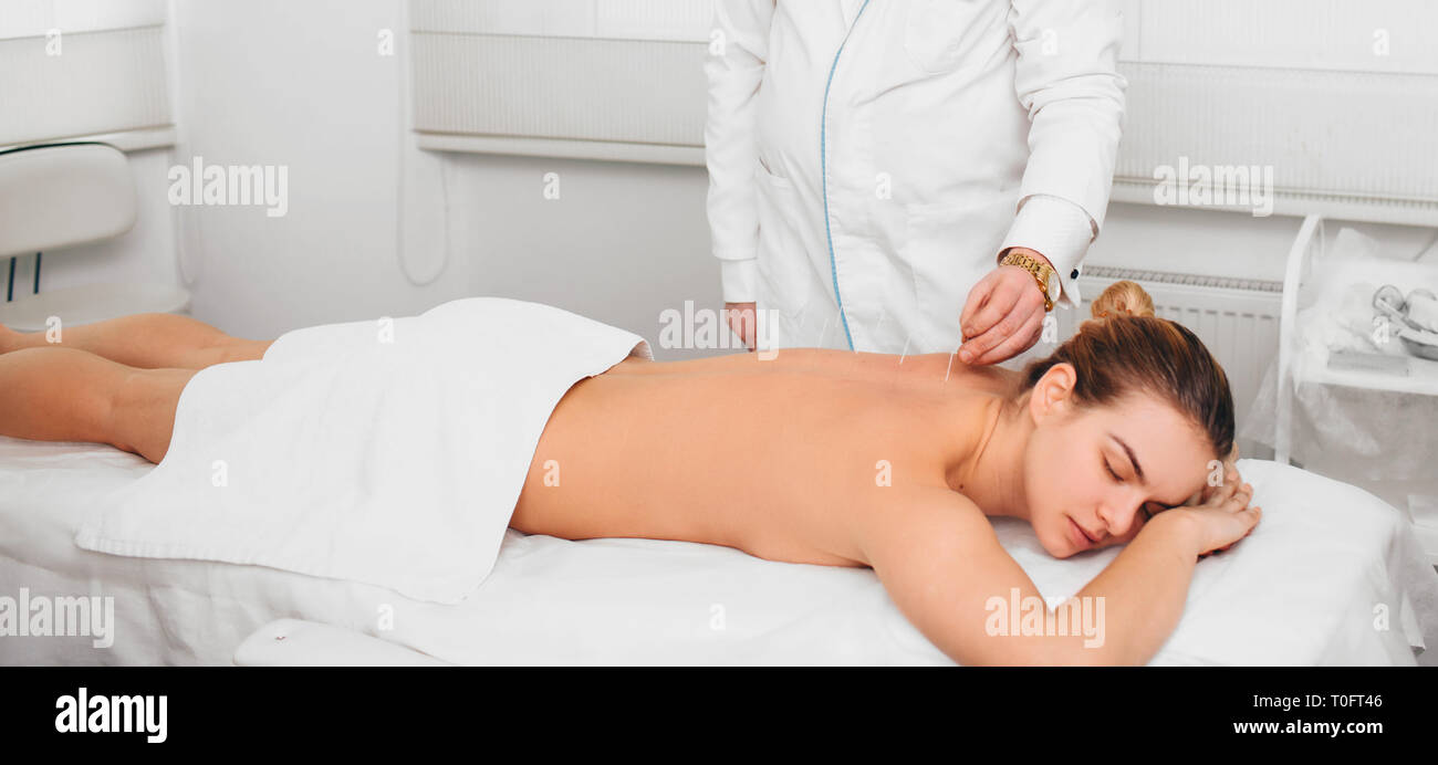 Cliente teniendo tratamiento de acupuntura sobre su espalda Foto de stock