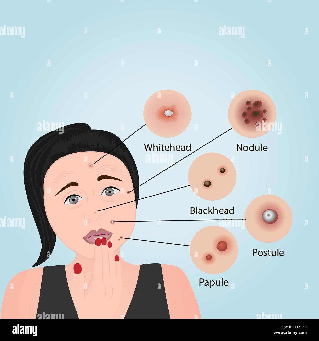 Tipos de acné un rostro ilustración vectorial. Cosmetología, cuidado de la piel, tratamiento de Imagen Vector de stock - Alamy