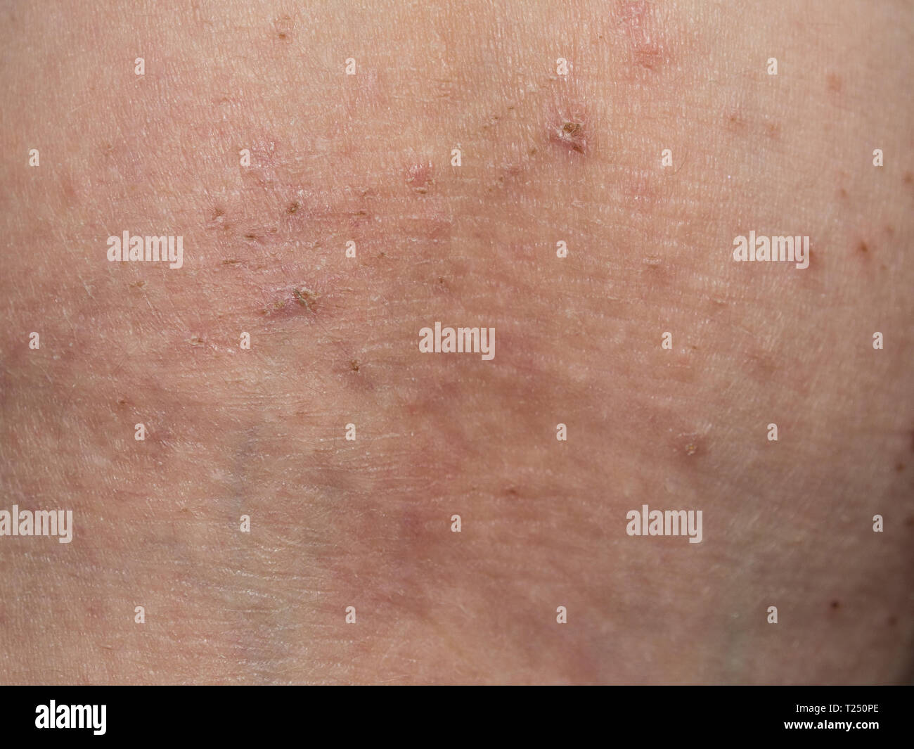 Una erupción en la piel. Close-up de una erupción en la piel alérgica. Foto de stock