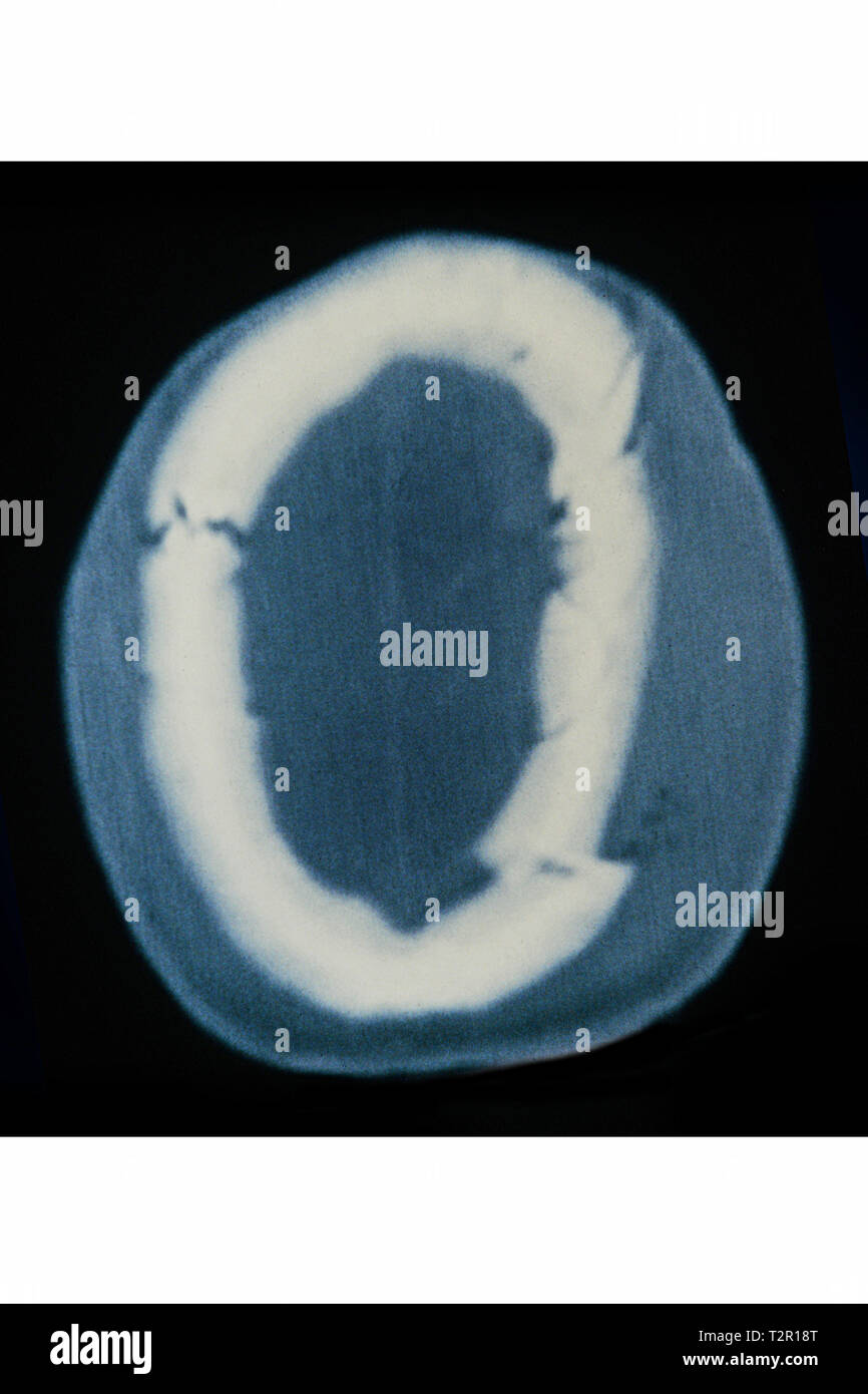 Fractura del cráneo Fotografía de stock Alamy