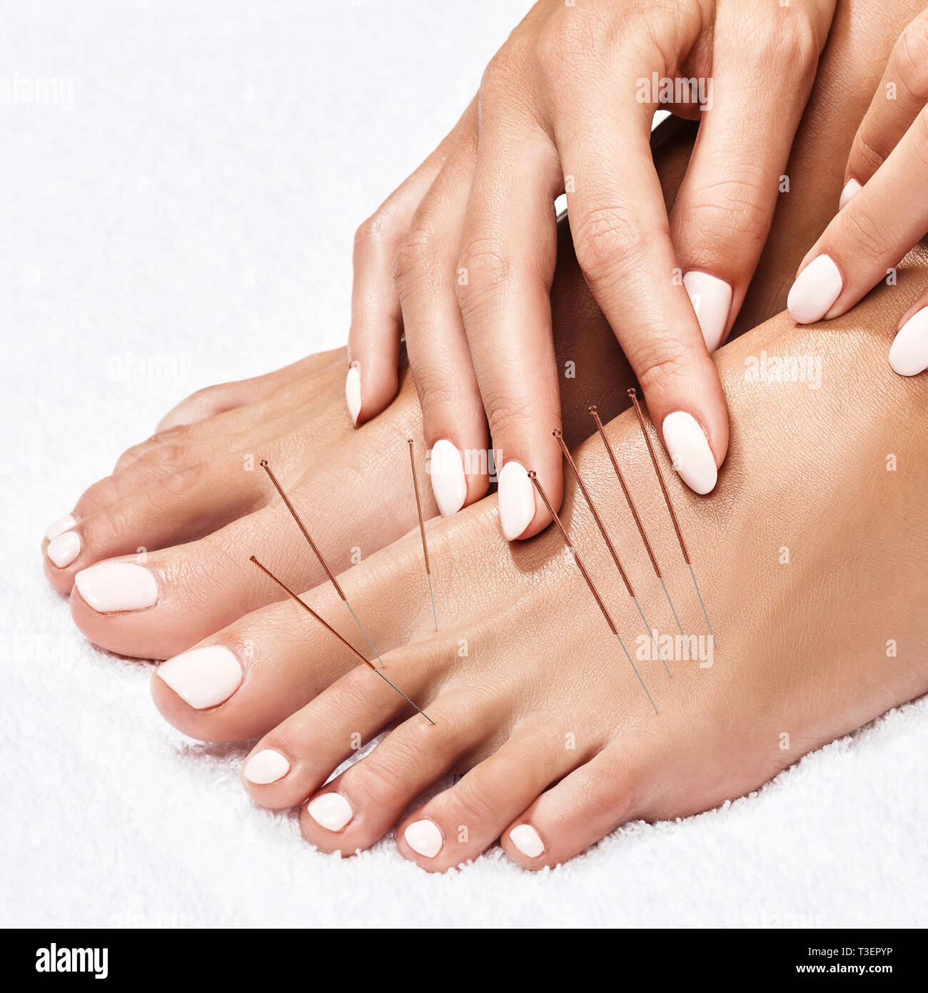 Piernas femeninas con inserción de agujas de acupuntura. Foto de stock