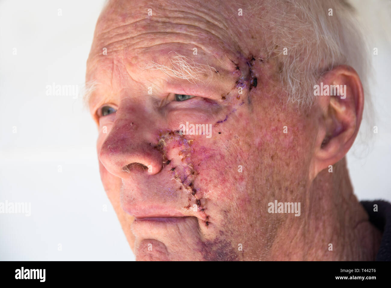 Ancianos varones caucásicos un día después de la cirugía para eliminar los cánceres de la piel en la mejilla y el templo. Foto de stock