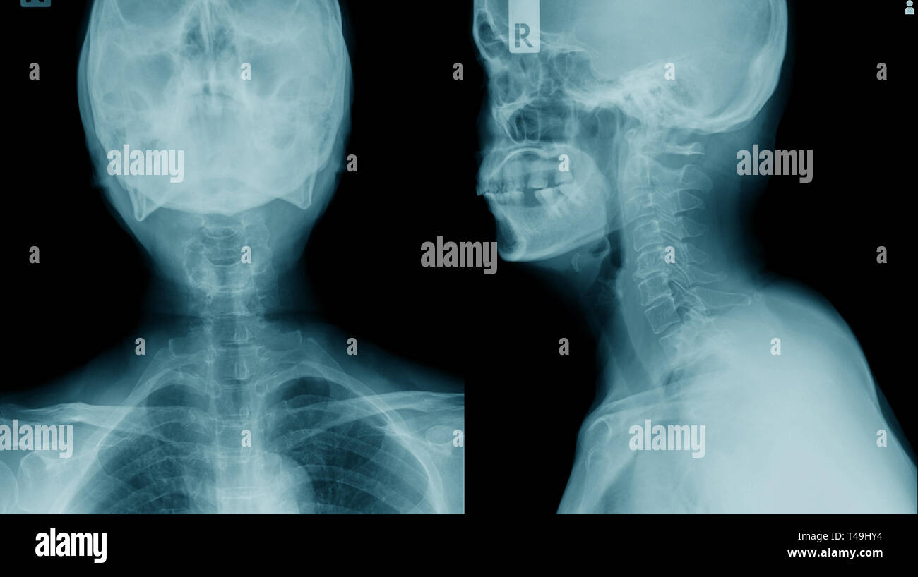 X ray C Cervical Caso Espondilosis Cervical La Imagen De Rayos X 