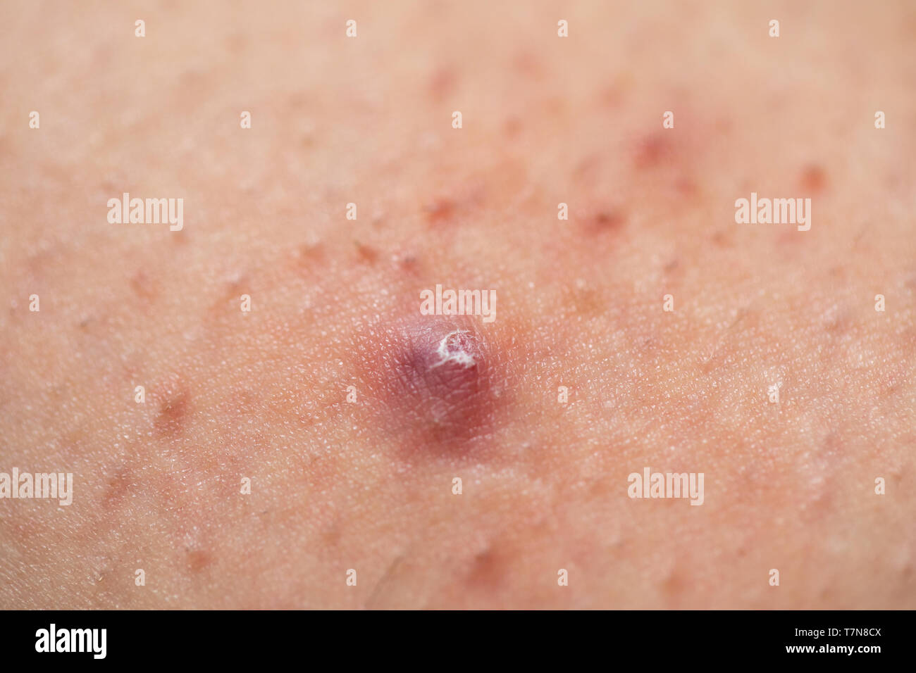 Foliculitis fotografías e imágenes de alta resolución - Alamy