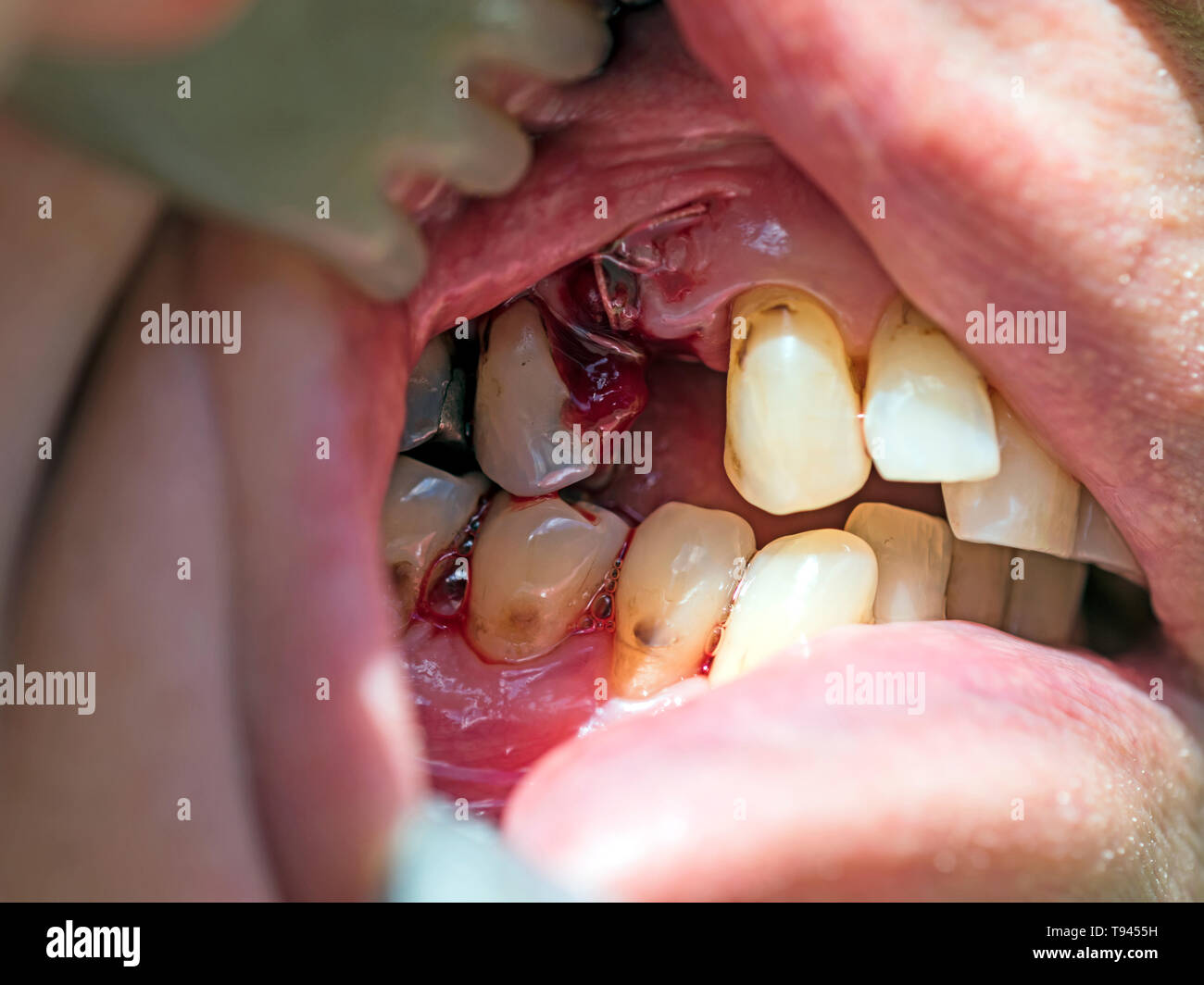 Erosión dental fotografías e imágenes de alta resolución Alamy