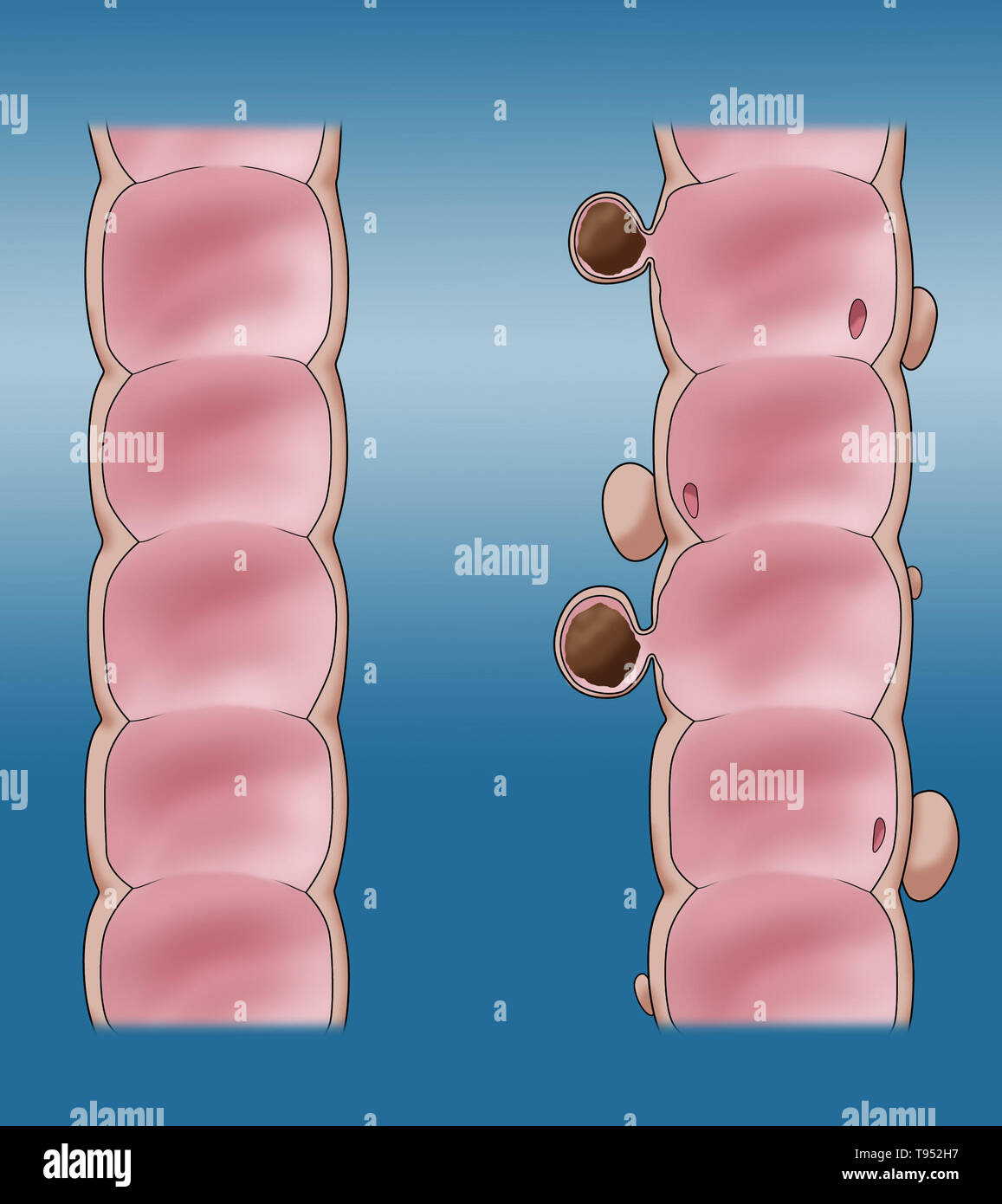 Ilustración comparando la apariencia de un colon sano (derecha) a uno con la diverticulosis (derecha). Foto de stock