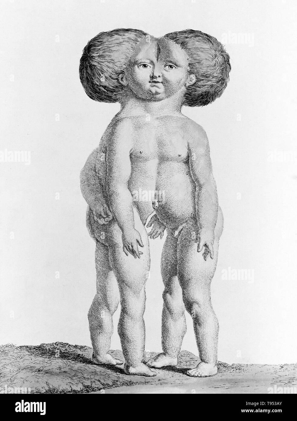 Siameses, desde 1775. Grabado por Nicolas-Francois Regnault y titulado 'Doble niño'. Foto de stock