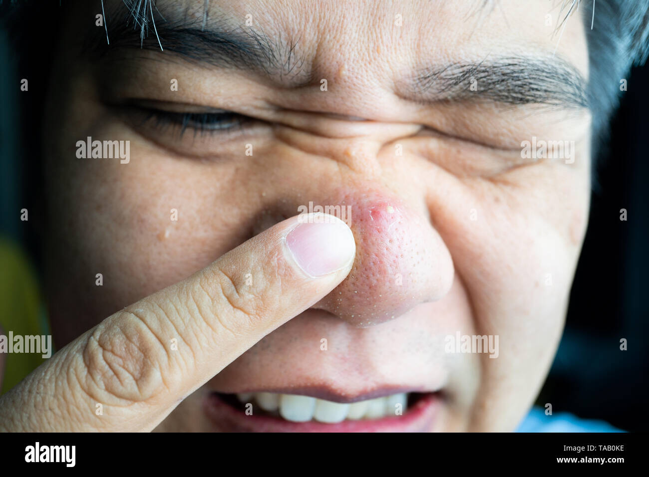 Grano en la nariz fotografías e imágenes de alta resolución Alamy