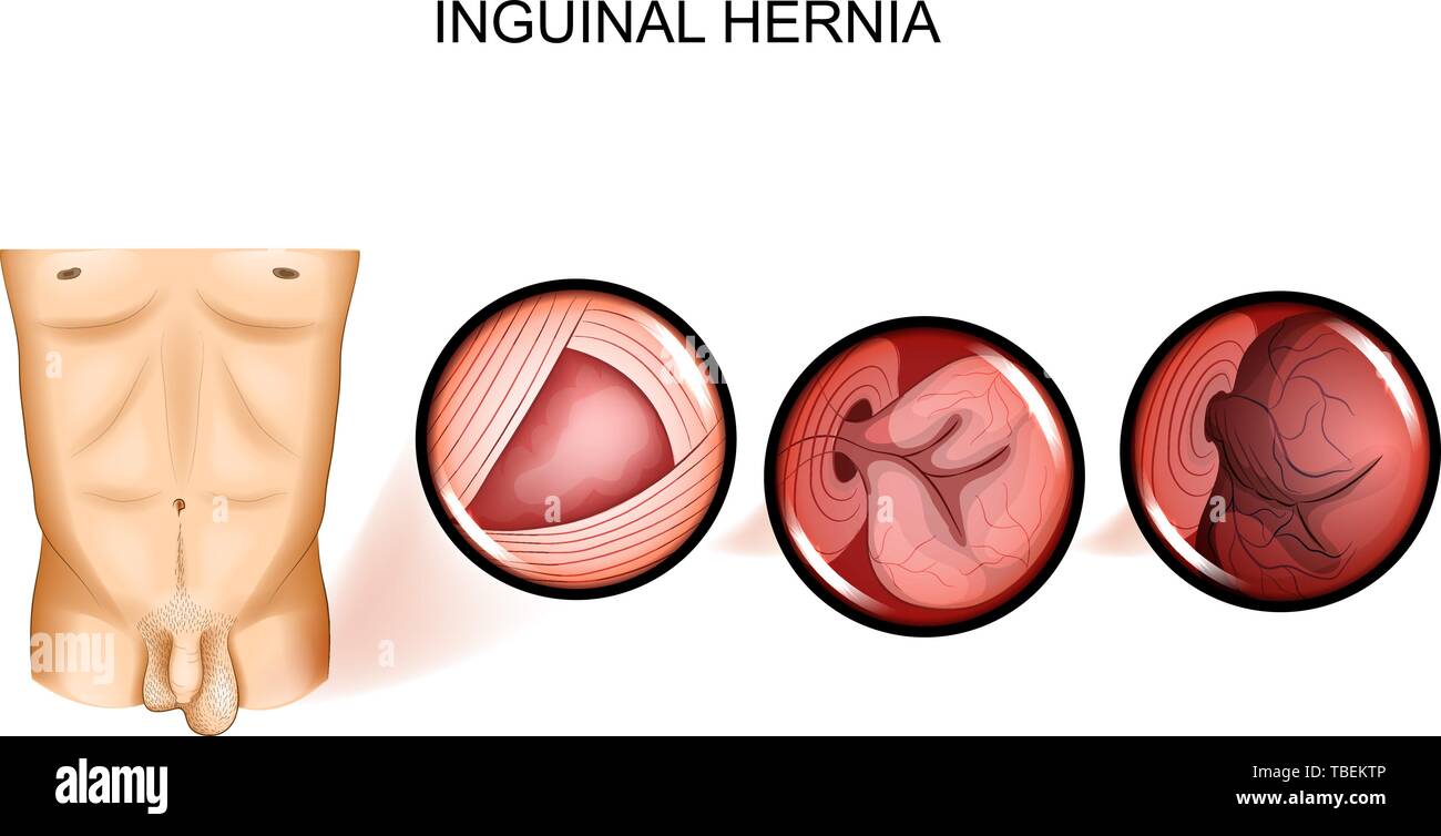 Fotos de Hernia Inguinal Del Vendaje Hombre Está Ceñido Con Cinturón Hernia  - Imagen de © Yunava1 #229094912