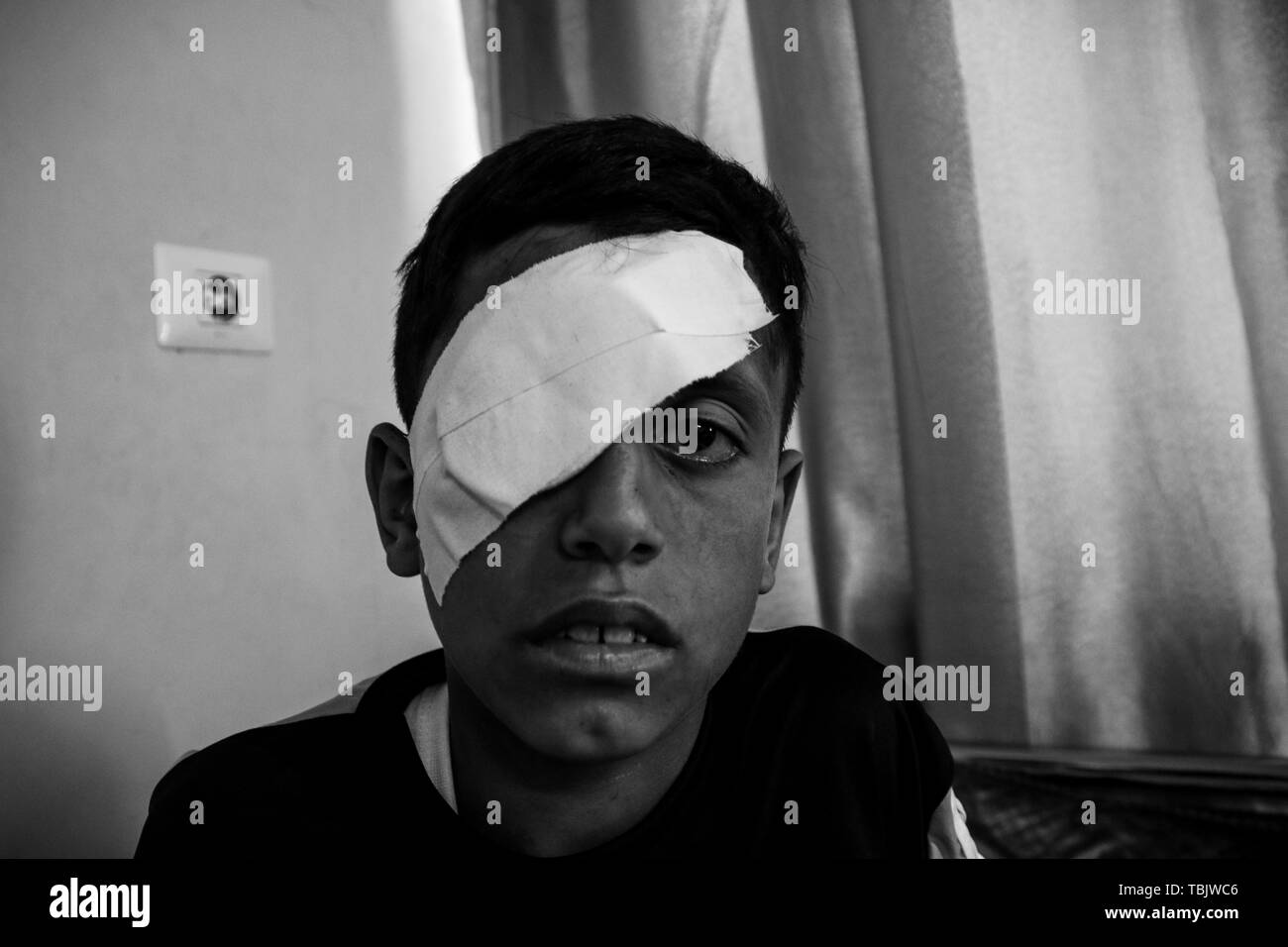 En Beit Hanoun, en Palestina. El 2 de junio de 2019 - 2 de junio de 2019. Al Baraa Fayeq Ahmed al-Kafarneh, de 11 años, recibe atención médica en un hospital tras haber sido heridos por soldados israelíes el viernes las protestas en la frontera Abu Safiya área en el norte de Gaza. Â El muchacho perdió su ojo inmediatamente después de ser disparado por un soldado israelí con una bala de goma y a pesar del trato recibido en un hospital oftalmológico en la ciudad de Gaza. Según un informe publicado por el "Save the Children" organización a fines de marzo pasado, en leastÂ beenÂ 49Â niños han muerto en la frontera de Gaza valla desde el inicio de la Gre C Foto de stock