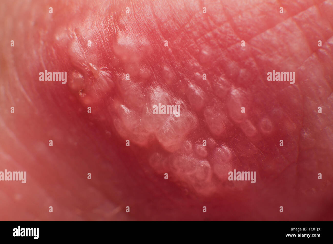 A partir de la creciente herpes en caucásicos hombre sobre el labio superior delantero microscopio super macro Foto de stock