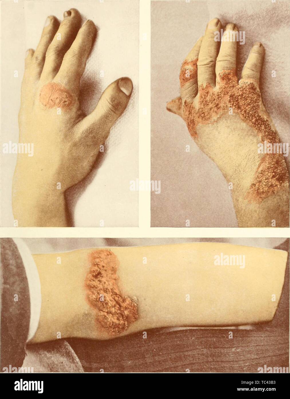 Grabados de manos humanas infectadas con tuberculosis verrucosa cutis