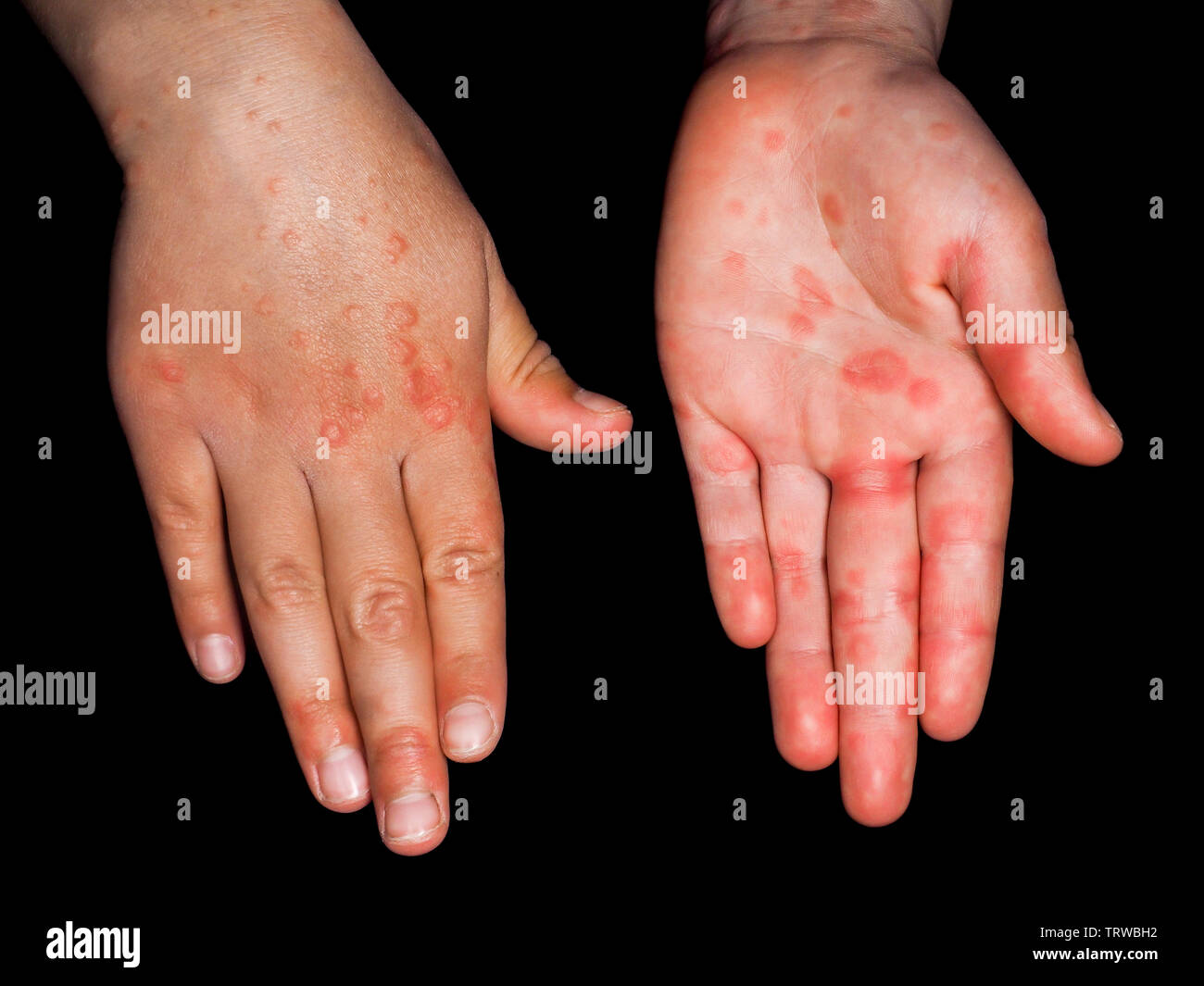 Niño con sarpullido rojo desde el virus de Coxsackie, en ambas manos, con  las palmas, y en el reverso, aislado sobre negro Fotografía de stock - Alamy