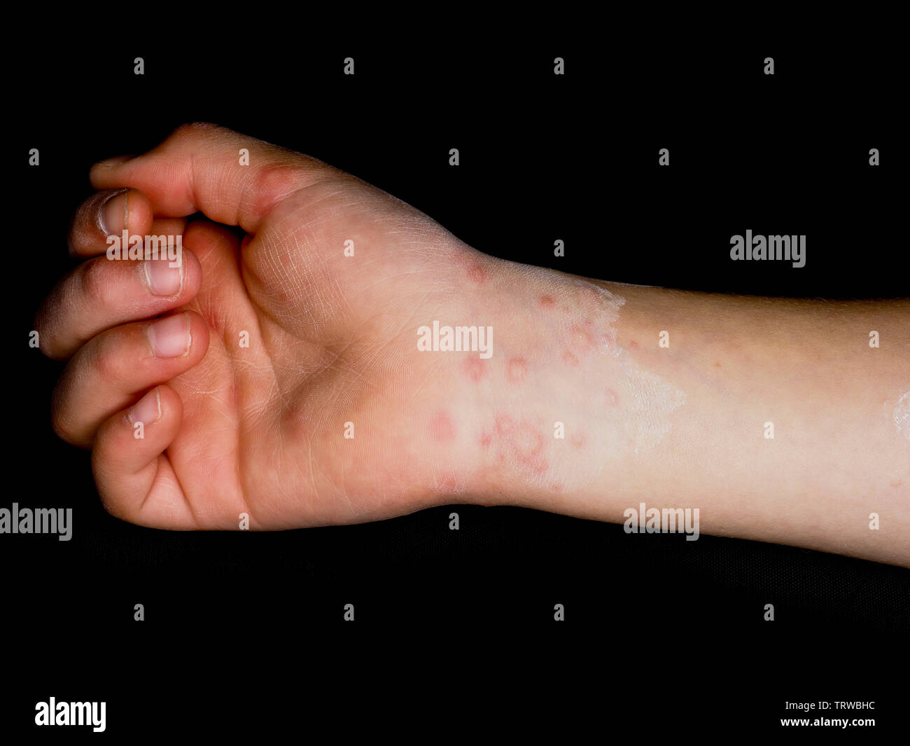 Niño con sarpullido rojo desde el virus de Coxsackie, sobre la palma de la  mano y muñeca derecha, aislado sobre negro Fotografía de stock - Alamy