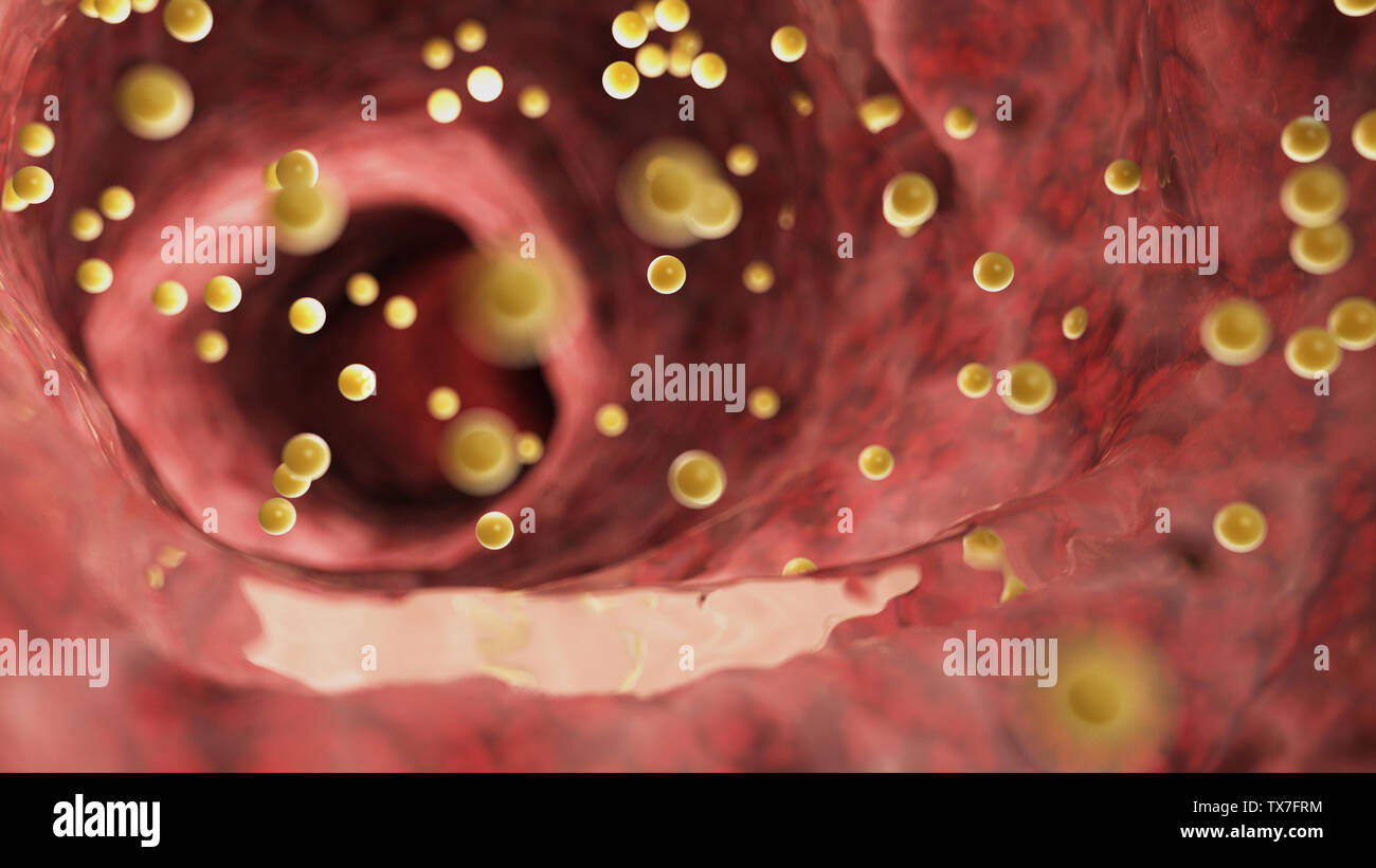 3D prestados ilustración médica exacta de colon la inflamación causada por el gluten Foto de stock