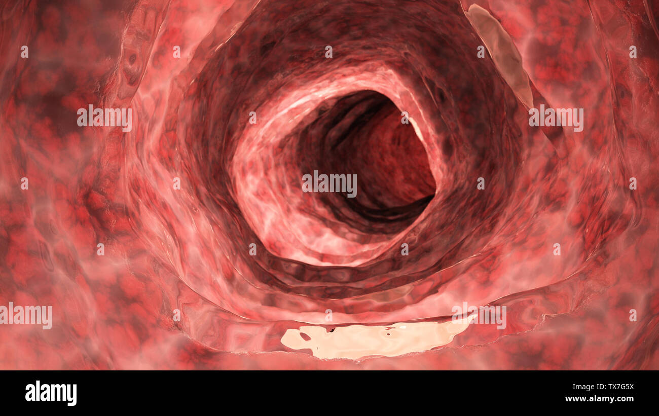 3D prestados ilustración médica precisa de un colon inflamado Foto de stock