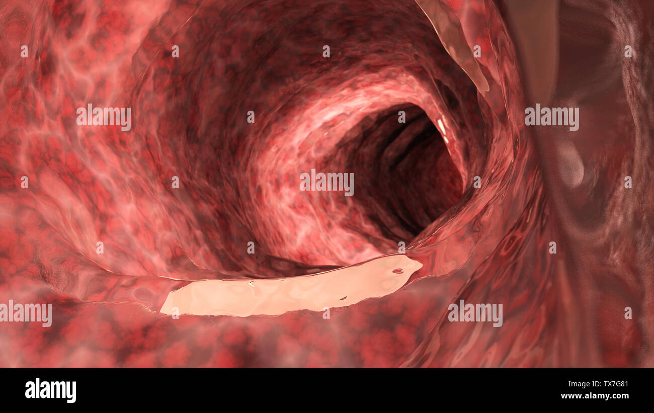 3D prestados ilustración médica precisa de un colon inflamado Foto de stock