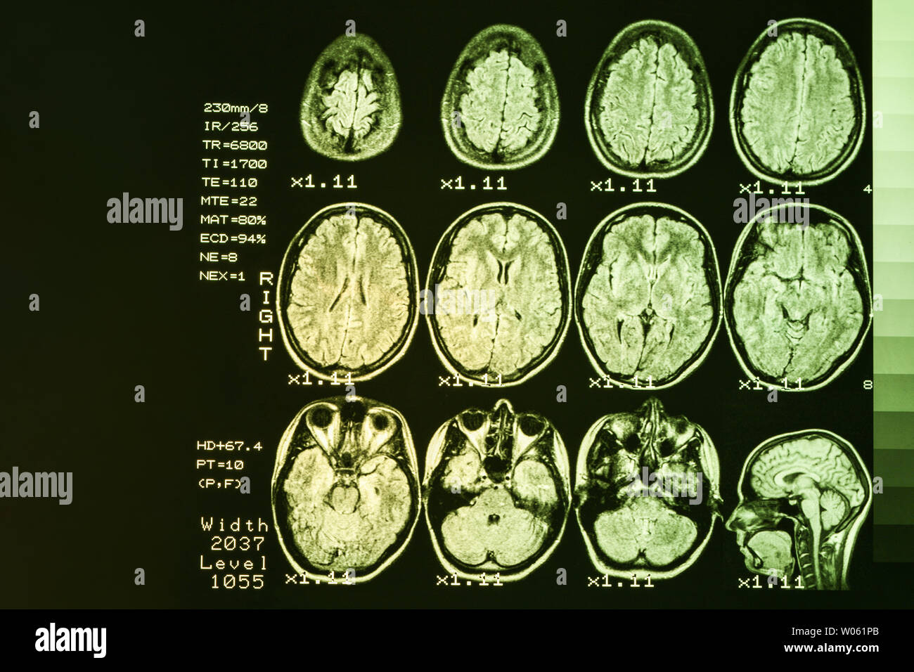 Resonancia magnética o imagen de resonancia magnética de la cabeza y el cerebro scan. El resultado es una imagen de resonancia magnética del cerebro con valores y números con retroiluminación de color amarillo. Foto de stock