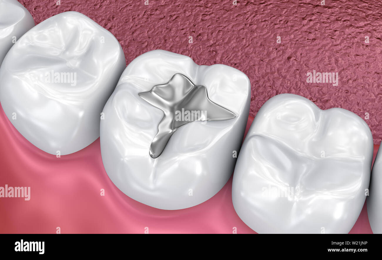 Empaste Dental Temporal Fotos e Imágenes de stock Alamy