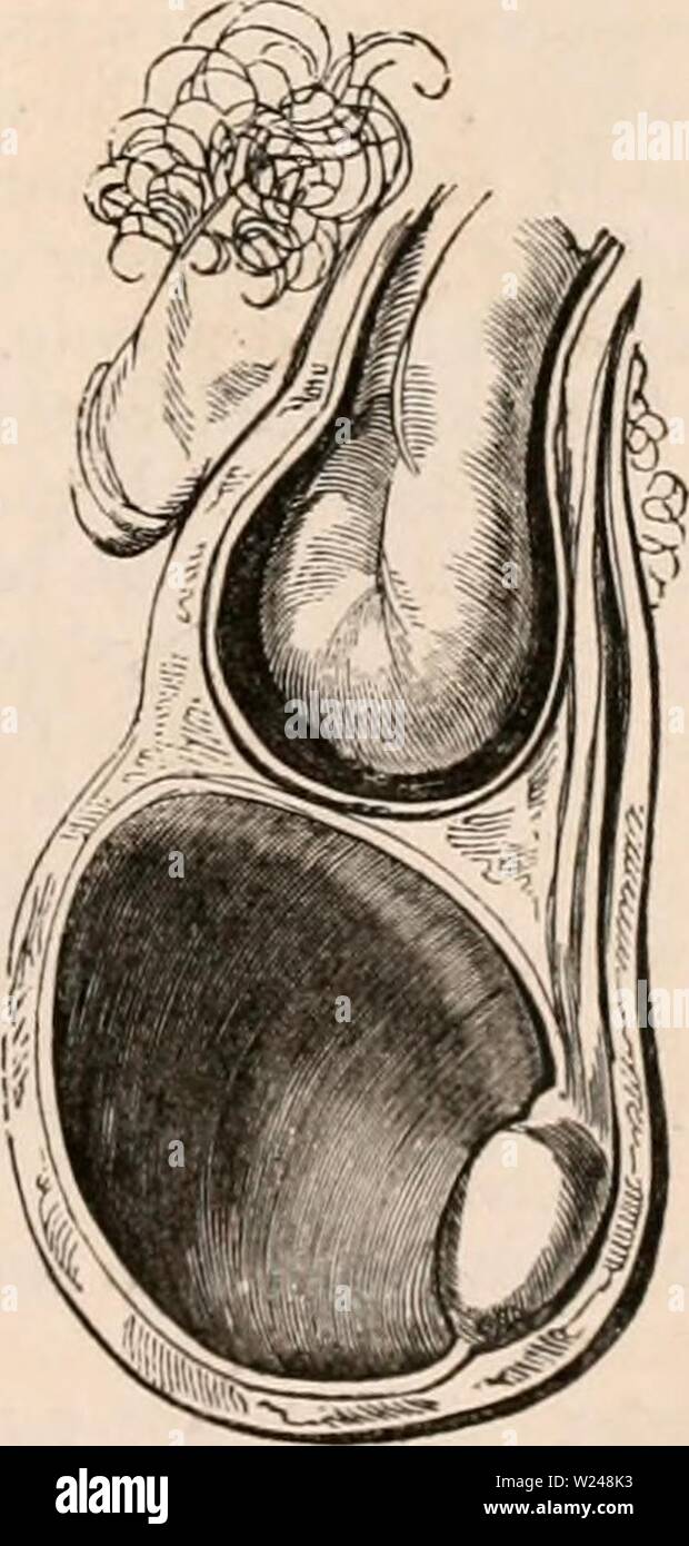 Imagen de archivo de la página 216 de la cyclopaedia de anatomía y. La  cyclopaedia de anatomía y fisiología cyclopdiaofana0402todd Año: 1849 sentó  abierta, y parte de la del hidrocele encysted parietes