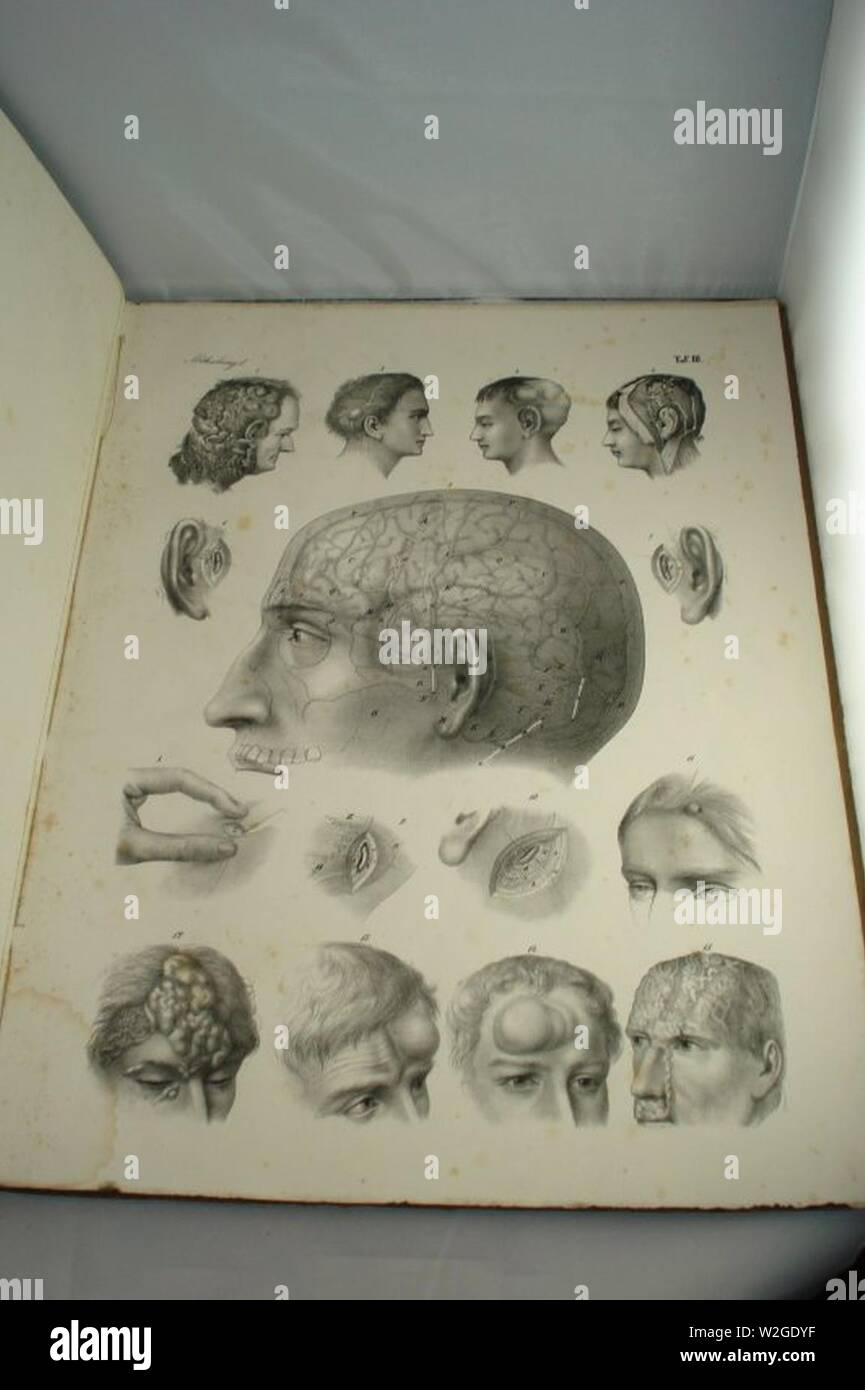 Atlas Chirurgischer Krankheiten der chirurgischen von Dr. Victor Bruns, 1853 (13). Foto de stock