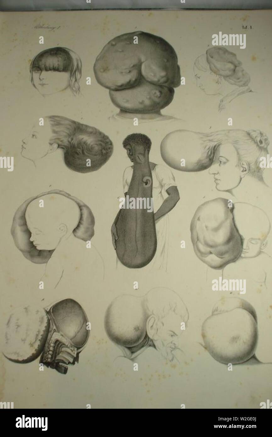 Atlas Chirurgischer Krankheiten der chirurgischen von Dr. Victor Bruns, 1853 (15). Foto de stock