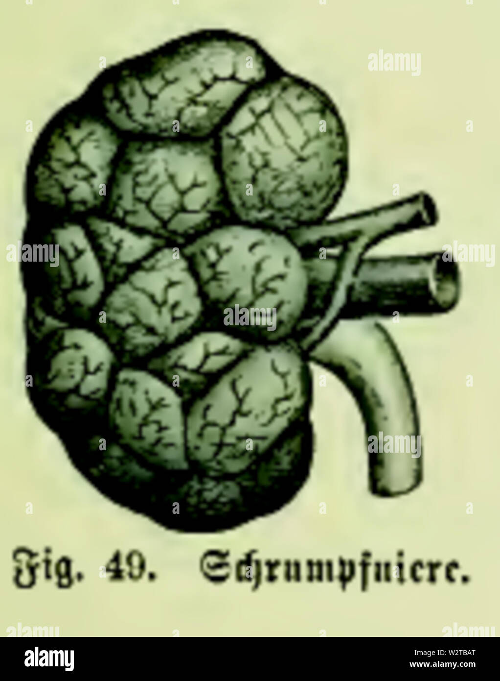 Schrumpfniere fotografías e imágenes de alta resolución Alamy