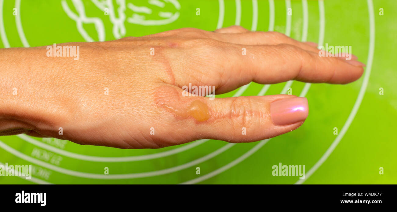 Quemaduras, ampollas de aceite hirviendo en la mano mujer closeup  Fotografía de stock - Alamy