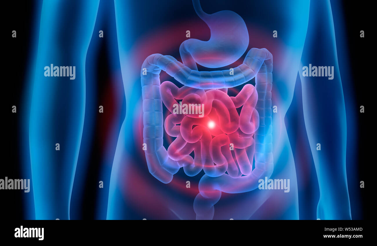 Infección intestinal del estómago - intestino enfermedad - Ilustración 3D Foto de stock