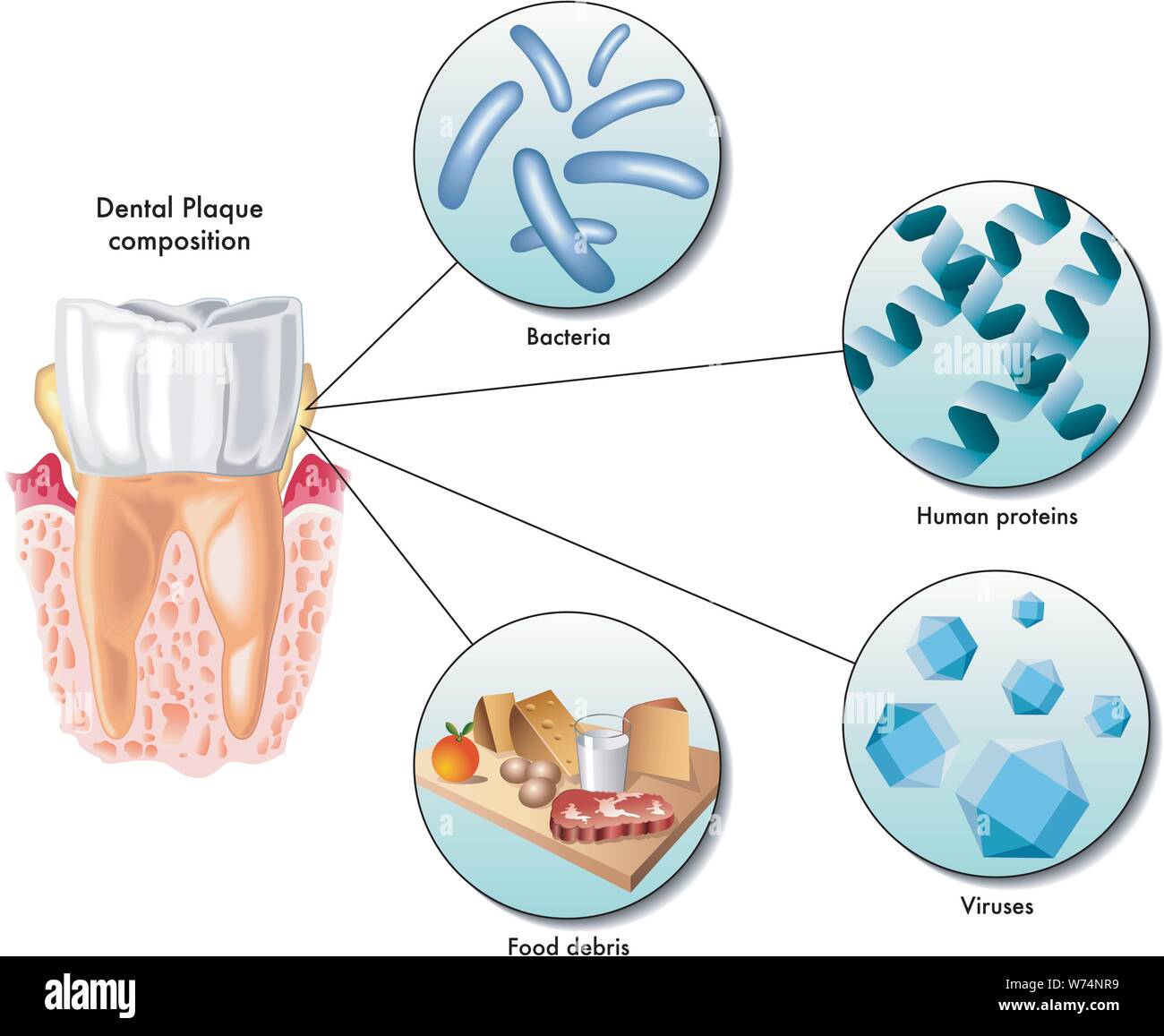 Ilustración médica de la composición de la placa dental Ilustración del Vector