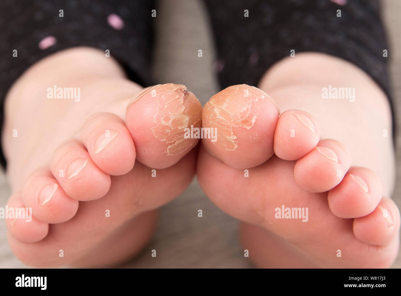 Vista cercana de 4 años de edad chica con grietas en sus dedos gordos de los pies. Concepto de mala condición de la piel. Foto de stock