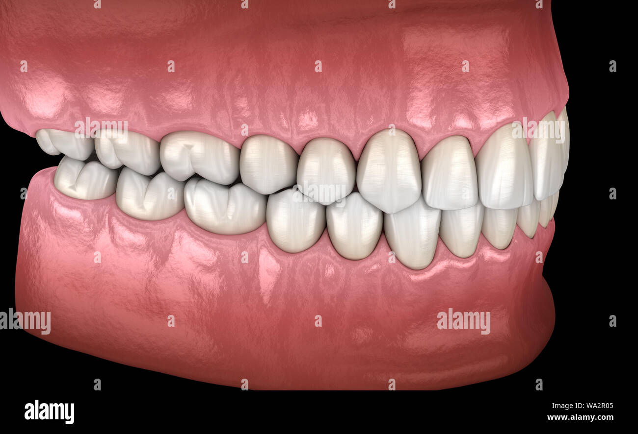 Los dientes humanos sanos con oclusión normal, vista lateral. Diente