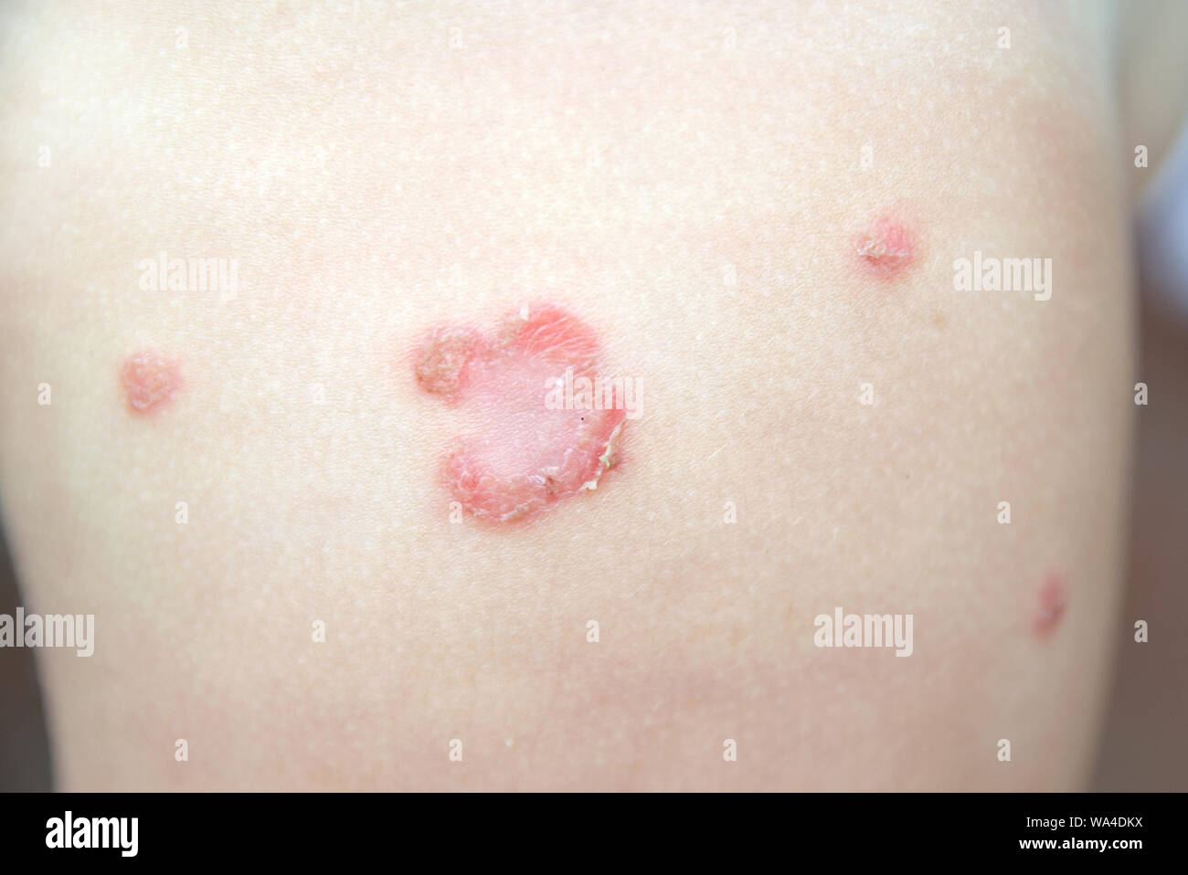Impetigo Child Fotos E Imagenes De Stock Alamy