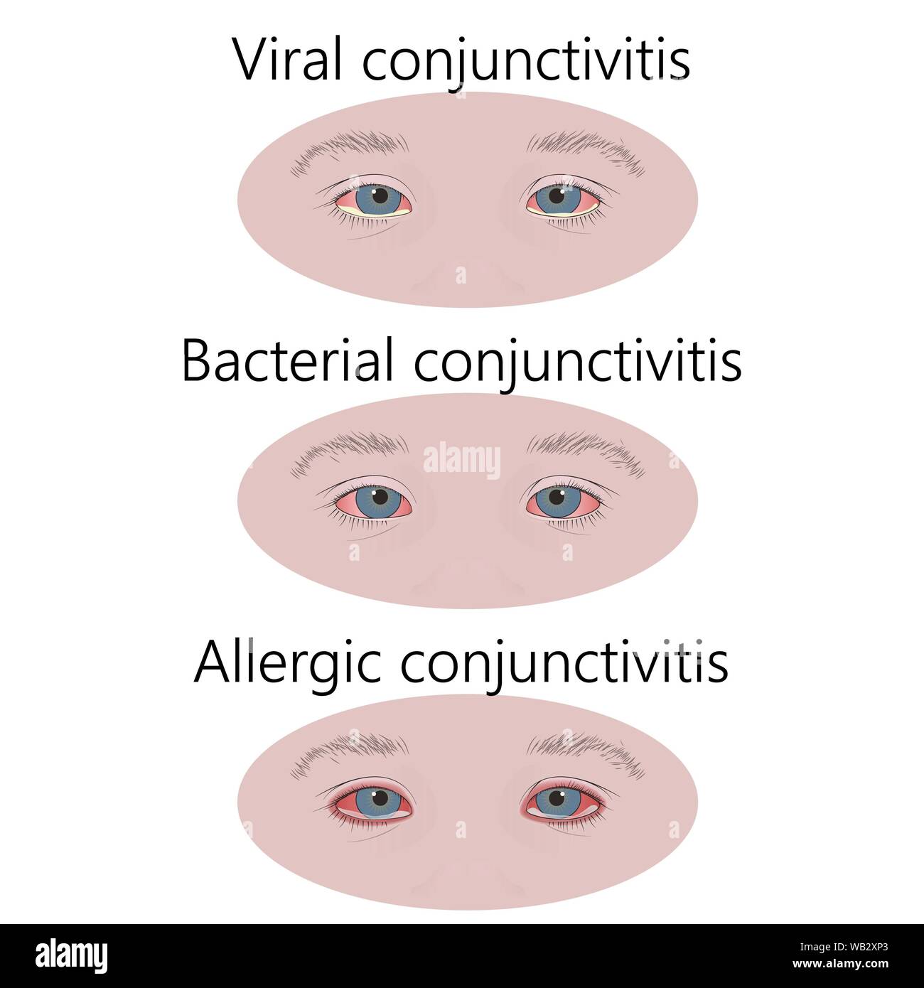Tipos de conjuntivitis, la ilustración. Comparación de alérgicos, conjuntivitis bacterianas y Tipos de conjuntivitis, la ilustración. Comparación de alérgicos, conjuntivitis bacterianas y