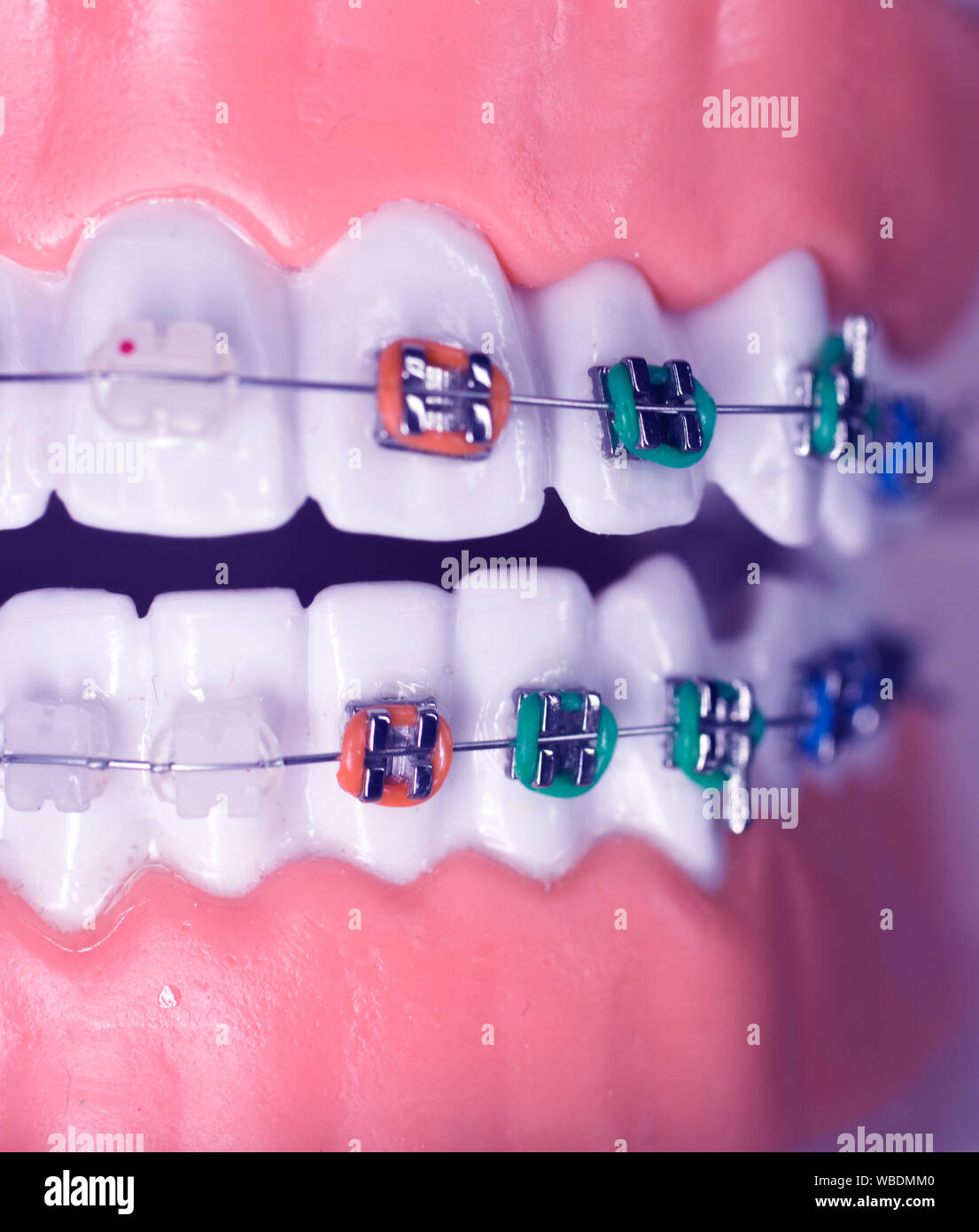 Los retenedores de metal y plástico moderno algners hilo dental dientes  soportes de las planchas Fotografía de stock - Alamy