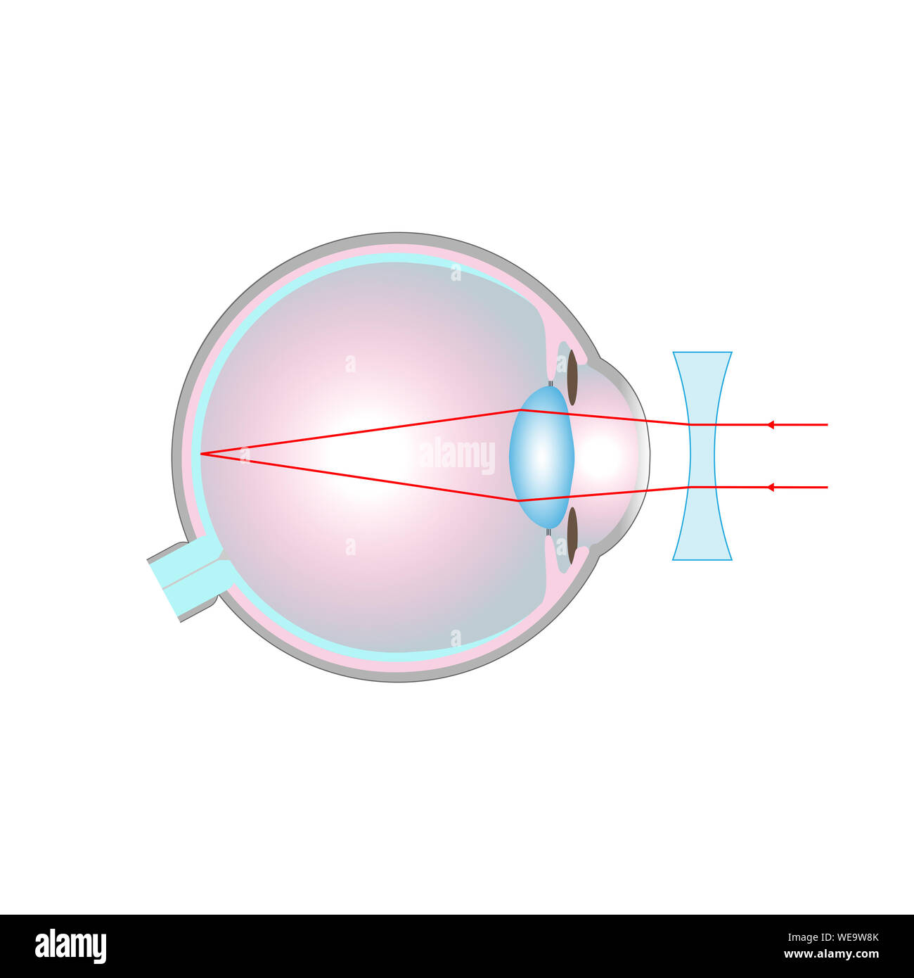 Trastorno de la visión, la ilustración. Visión corta (miopía) corregida con una lente cóncava. Foto de stock
