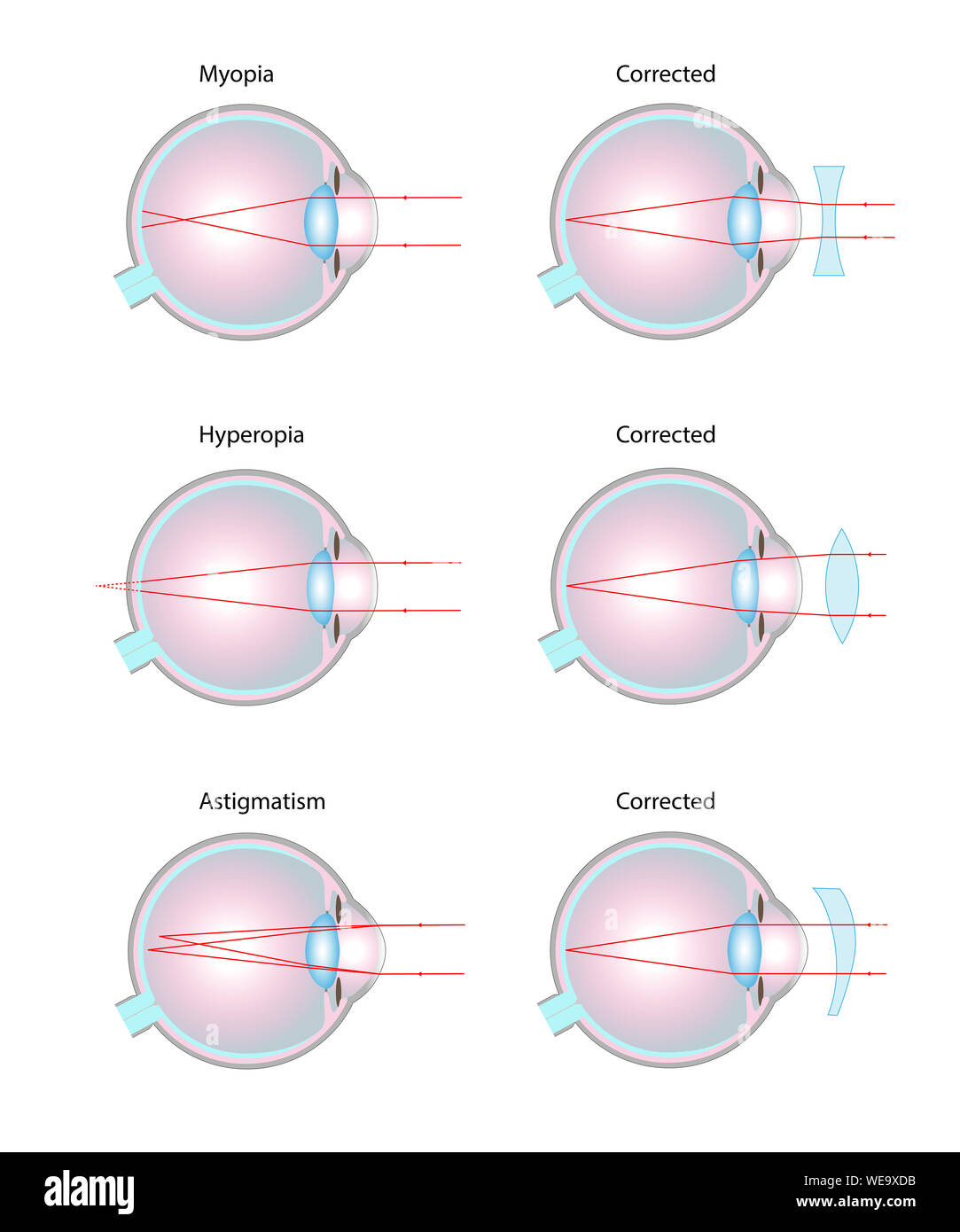 Ser Nublado estar impresionado Trastornos de la visión y lentes correctivos, ilustración. Miopía/miopía (arriba), hipermetropía o hiperopía (oriente), astigmatismo (abajo Fotografía de stock - Alamy Ser Nublado estar impresionado Trastornos de la visión y lentes correctivos, ilustración. Miopía/miopía (arriba), hipermetropía o hiperopía (oriente), astigmatismo (abajo Fotografía de stock - Alamy
